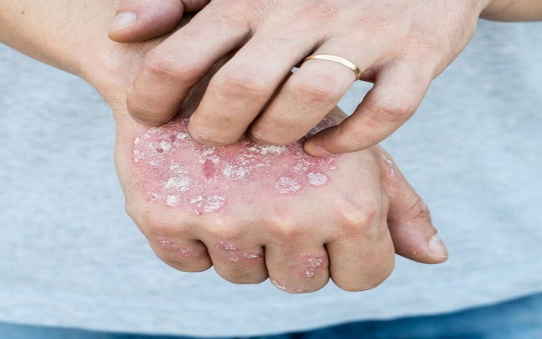 Psoriasis oder Schuppenflechte kann mit Cannabis gelindert werden