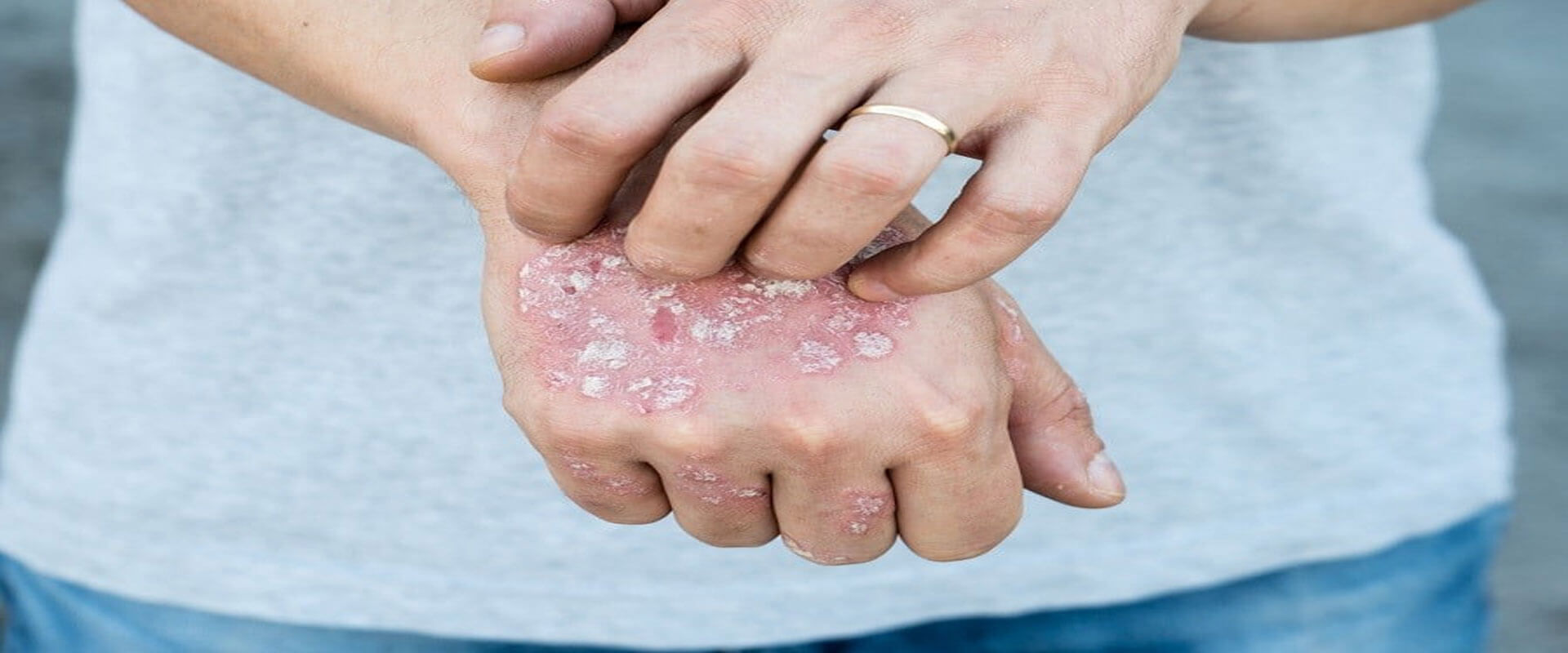 psoriasis-kann-mit-cbg-behandelt-werden-2020-canbys-beste-bio-produkte